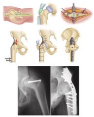 1-mc & C indication for 1^ hip arthrodesis? C
2- MC & C reason for Conversion of fusion to THA?
3- why obtain preop EMG prior to THA? if abn then how does that change to THA?
4-optimal position of THA? what is to be avoided and why?
5-MC prefe...