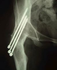 You are caring for an 18-year-old boy with severe hip arthritis and pain from a missed slipped capital femoral epiphysis. You decide that a hip arthrodesis is the best treatment option. What is the optimum position for a hip arthrodesis to maximiz...