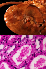 *Another (older) name for MCD. 

*We see yellowish discoloration of renal cortex from deposits of lipid in MCD.
*There are lipid droplets in proximal tubular cells: fine vacuolization (bubbly cytoplasm), reflecting lipiduria secondary to hyperl...