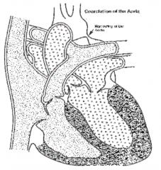 Narrowing of the aorta near the ductus arteriosus
- Preductal - tubular hypoplasia of the aorta by PDA (congenital)
- Postductal - ridgelike infolding of aorta after ligamentum arteriosum, without PDA (adult)