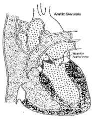 - Stenosis: Aortic valve obstruction d/t hypoplasia, dysplasia or abnormal number of cusps, causing narrowing of the opening/outlet
- Atresia: absence of aortic valve