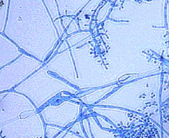 																											Skin scrapings from a patient with athlete’s foot are submitted for fungal culture. The colonyand lactophenol cotton blue preparation of the colony are seen below. What is the mostlikely identification of this organism...