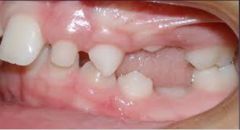 Ankylosed primary tooth