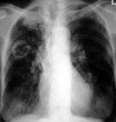 - classic findings are upper lobe infiltrates with cavitations
- may see pleural effusions, Ghon's and Ranke's complexes- evidence of healed primary TB (- Ghon's complex- calcified primary focus with an associated lymph node
- Ranke's comples- w...