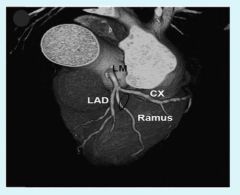 Left coronary artery can trifurcate instead of bifurcate, into anterior interventricular branch, circumflex branch, as well as the variation of a "Ramus Branch" in between