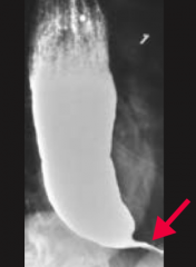 A patient presents with dysphagia to solids and liquids; a barium swallow test shows a "bird's beak" appearance. What is the most likely diagnosis? What is this patient at risk for?