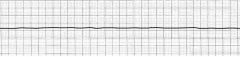 Vad visar EKG:t?