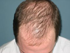 Androgenic alopecia aka male-pattern baldness. Fronto-temporal areas progress to vertex, entire scalp may be bald

Androgenic alopecia is the most common cause of hair loss and thinning in humans. Variants appear in both men and women. In classi...