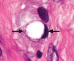 What does this show histologically? Sign of?