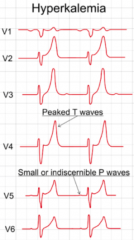 - Reduction of P wave amplitude
- Widening of PR interval 
- Widening of QRS complex
- Decreased force of contraction
- Accelerates repolarization, shortening duration of AP
- Shortens QT interval
*Characteristic tall T wave peaks