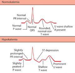 - Slowing of repolarization, prolonging AP duration
- Flattening of T wave or inversion 
- Increased amplitude of P wave
- Pronounced U wave
- Prolongation of PR and QT intervals
- Can cause AV block and ventricular fibrillation
