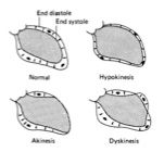 healed infarcts (hypokinesis, akinesis, dyskinesis)

wall motion of a chamber: 
Normal chamber: ventricle is larger in diastole, ventricle is smaller in systole.  
HYPOKINESIS: space is smaller indicating under movement/under pumping.  still h...