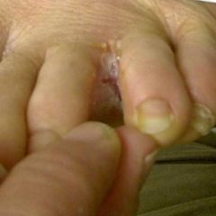fungal infection on the foot. 

Rx
Lamisil 1% cream
Apply to affected areas bid         M: 30g     repeat:1