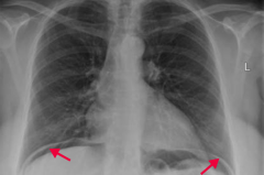 - Anterior wall > Posterior wall
- May see free air under diaphragm on CXR
- Referred pain to shoulder