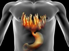 "Heart burn"

Retrosternal chest pain that is caused by reflux of esophageal contents into the esophagus that irritates the lining