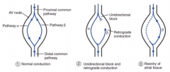 - Premature atrial contraction may penetrate slow pathway in antegrade direction 
- May block antegrade in still-refractory fast pathway
- Upon reaching turn-around point, if fast pathway has recovered from refractory period, impulse penetrates ...