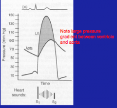 Systolic murmur due to turbulent flow into aorta

Heard in crescendo decrescendo manner
Associated with high end diastolic volume and low stroke volume/ejection fraction.