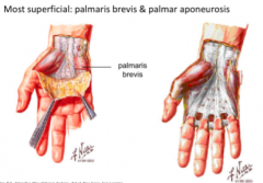 palmer aponeurosis 
divides palm into three compartments 


contracture of palmar fascia- (dupuytrens) 
thickening and shrinking- two littlest fingers contract 
