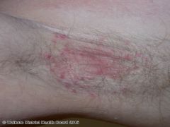 Ill-defined salmon-pink thin patches. Common in axilla and groin creases. Fluctuates in severity. May be asymmetrical. Often unnoticed. Red patches on face and scalp tend to be flaky