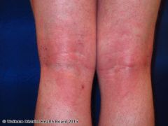 First occurs in infancy. Common in elbow and knee creases. Characterised by flares. Very itchyAcute eczema is red, blistered, swollen. Chronic eczema is dry, thickened, lined (lichenified)
