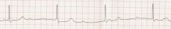  A 53-year-old man presents with dyspnea on exertion and near-syncope. His ECG is shown above. What treatment should emergently be initiated?