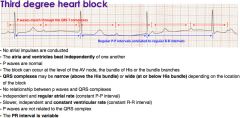 Transvenous pacemaker.
This patient presents with symptomatic third degree heart block and should have a transvenous pacemaker placed. Third degree AV block (or complete heart block) is defined as an absence of conduction of atrial impulses accomp...