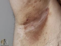 skin fold rash caused by Corynebacterium minutissimum. associated with obesity, poor hygeine, immunicompromise, diabetes, excessive sweating