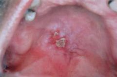 Exuberant squamous metaplasia
Inflammatory response in minor salivary glands
Can be misinterpreted as a malignant process