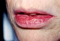 Nodular swollen lower lip of adult males

Can express saliva

Nonspecific histologic finding, hyperplasia, fibrosis and ectasia