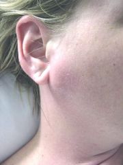 Parotitis - acute suppurative sialadenitis of the parotid gland

Unilateral painful swelling and pus from Stensen's duct