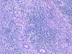 Kuttner's tumor = chronic sclerosing sialadenitis

Heavy lymphoid infiltrate submandibular gland