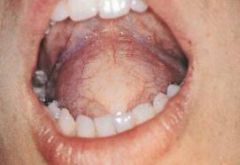 Dermoid cyst of floor of mouth is midline

Ranula's are unilateral