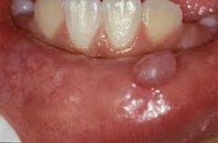 Lower lip (they are pseudocysts)