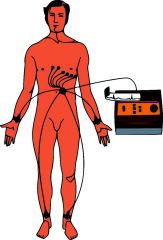 An ECG that uses 12 leads attached to the patient's skin; these include the limb leads and chest leads.
