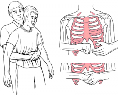 The preferred method to dislodge a severe airway obstruction in adults and children; also called the Heimlich maneuver.