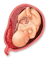 A premature separation of the placenta from the wall of the uterus.