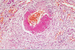 A 45-year-old white male trucker has been having fever, malaise, myalgias, weight loss, abdominal pain, bloody stools and variably sized, tender skin nodules for months, but he has delayed seeking medical evaluation because he lacks health
insura...
