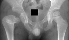 1-AP/frog-leg lat pelvic x-rays=may be nl, especially in early stages of dz, often see widening of the joint space, subluxation, or dislocation,
-in infants, prior to ossification ->fem head, widening of joint space -> lateral displacement of  pr...