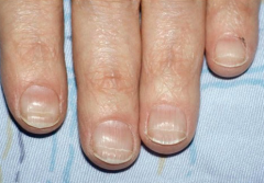 http://www.nailsmag.com/article/81742/what-are-beau-s-lines