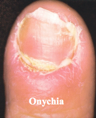 http://feindura.info/nail-disorders-onychia.html