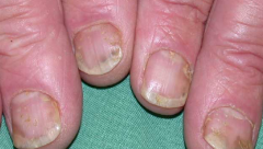 http://www.healthline.com/health/nail-psoriasis