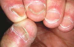 http://www.nailsmag.com/health/nail-skin-disorders/page/6
