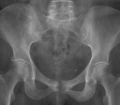 1-AP pelvis->osteolytic pubis w/ bony erosions & often times diastasis of the symphysis
1.1sx=vague, ill-defined pain is anterior pelvic region, worse with activities involving hip add/abd @ ant pelvis, may have spasms with hip add
1.2PE=localiz...