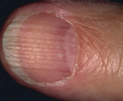 http://doctorv.ca/medical-conditions/nails/onychorrhexis-age-related-nail-changes/