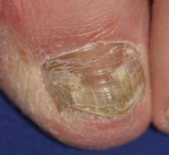 http://www.podiatrytoday.com/how-treat-dystrophic-nails