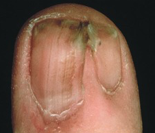 http://nailstyling-fiedler.info/nail-disorders-milady.html