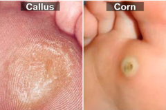 http://www.treatcure.com/corns/corns-feet-bottom-ball-side-heel-hard-painful-pictures-causes-removal-treatment-prevention/