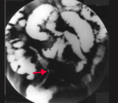 Which form of IBD is characterized by "string sign" on barium swallow x-ray?