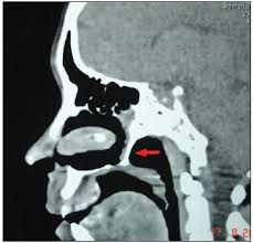 Unilateral choanal atresia:
-5-24 months with unilateral obstruction, nasal discharge