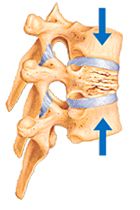 Occurs when one or more bones in the spine weaken and crumple.